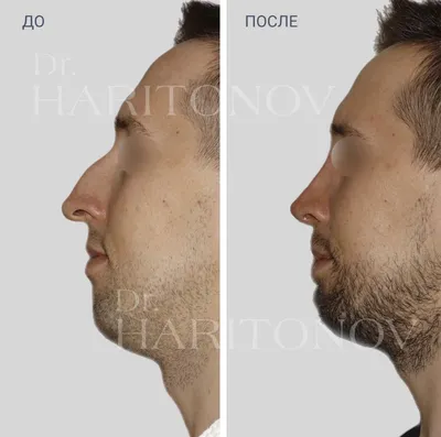 Ринопластика носа картошкой в Москве - цены, отзывы, реальные фото до и  после | Александр Маркушин пластический хирург
