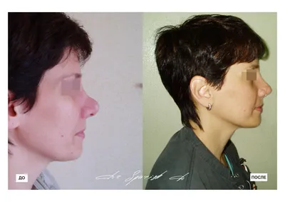 Ринопластика: фото до и после хирургической коррекции