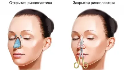 Ринопластика носа картошкой, фото до и после, как исправить, цена в Москве  для мужчин и женщин, отзывы