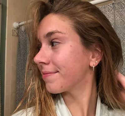 Результат ринопластики три месяца спустя | Beauty Insider