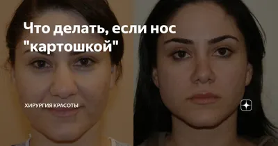НОС КАРТОШКОЙ БОЛЬШЕ НЕ ПРОБЛЕМА! Сужение носика 🤗 ✨Быстро (процедура  занимает 30… | Instagram