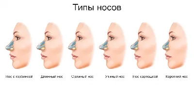 Длинный нос картошкой: фото после ринопластики | Куринной | Куринной С.И.  пластический хирург