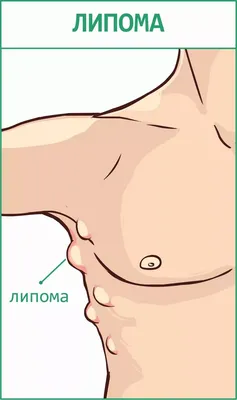 Удаление липомы, атеромы, гигромы лазером | PROMED