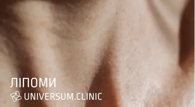 Удаление липомы | Damas Medical Center