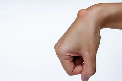 12 шт., пластырь для снятия Липомы | AliExpress