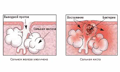 Плеоморфная липома | MyPathologyReport.ca