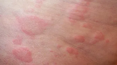 Аллергия на коже у детей. Как ее лечить?