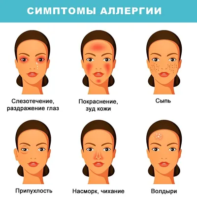 Несовершенство Кожи Аллергия На Кожу Болезнь Уртикария Красные Пятна На Коже  — стоковые фотографии и другие картинки Крапивница - состояние кожи - iStock