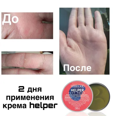 Аллергия на коже лица: виды аллергической сыпи у взрослого, лечение и фото,  чем лечить, снять реакцию, что делать с прыщами, как убрать и избавиться,  причины сильных высыпаний на шее