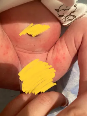 Evy Baby Kyrgyzstan - Есть 3 самые популярные причины аллергии на подгузник  у малыша: ❌неправильный размер ❌отдушка ❌специфическая аллергия на  материалы и компоненты. ⠀ 1️⃣неправильный размер подгузника приводит к  натиранию и излишнему