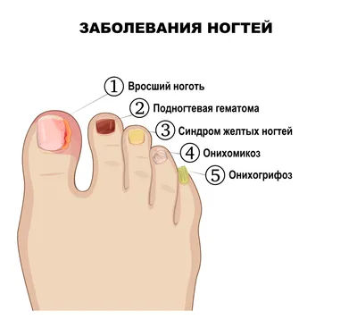 Белые пятна на ногтях: почему появляются и как избавиться | РБК Стиль