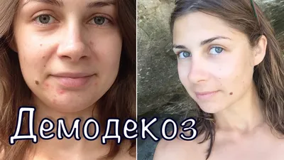 Лечение демодекоза