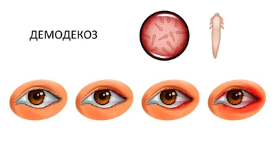 Демодекоз | Купрум