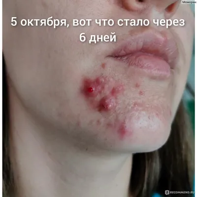 Подкожный клещ. Какие процедуры запрещены, а какие – показаны