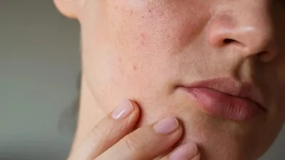 Демодекоз на лице: как выглядят высыпания | DermaQuest | Дзен