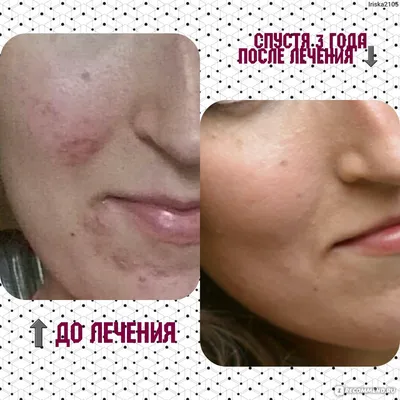 Демодекоз век у человека: лечение, причины, сиптомы