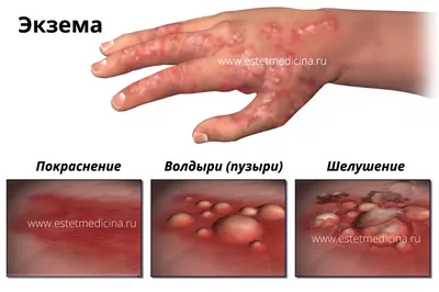 Экзема - причины и лечение в Санкт-Петербурге