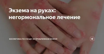 Экзема на руках: фото, лечение, причины, как выглядит на пальцах и как  навсегда избавиться от заболевания