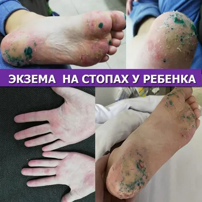 Мазь ООО \"Озон\" Синафлан - «Кожа, в которой я живу. ЭКЗЕМА. Расскажу о моем  способе лечения, который дал действительно хороший результат.» | отзывы