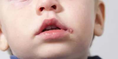 Герпес - симптомы, диагностика и лечение в клинике Universum Clinic