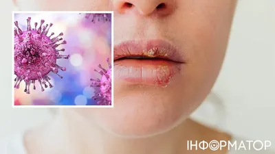 Опоясывающий лишай (герпес) — причины, симптомы, диагностика, лечение лишая  в Москве