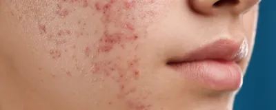 Как вылечить грибок кожи: симптомы болезни и возможное лечение грибка кожи