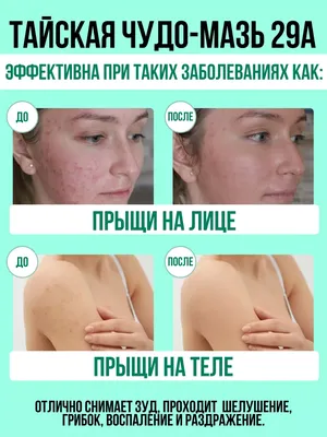 Мази от грибка на лице: выбор лучших препаратов