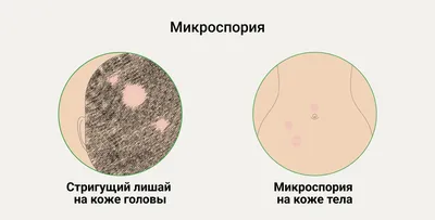 Грибок на лице картинки фотографии