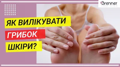 Лечение грибка кожи | Асмедия | Санкт-Петербург (СПб)