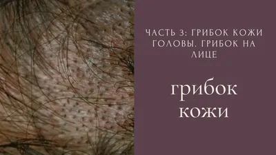 Лазерное удаление пигментных пятен на лице в Киеве ≡ MED CITY | Удаление  пигментного пятна на лице