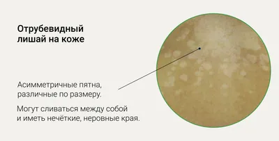 Удаление сосудистой сеточки на лице лазером в \"Семейной консультации\"