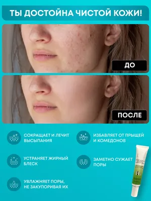 Лечение грибка кожи: как избавиться и чем лечить грибок кожи?