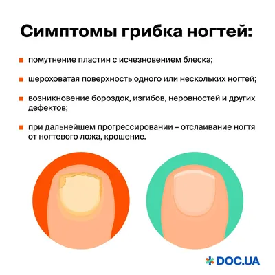 Лечение грибка ногтей в Самаре | Клиники доктора Кравченко