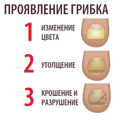 Клинические различия псориаза ногтей и грибка ногтей ✓ Авторские статьи  Клиники подологии Полёт в Москве