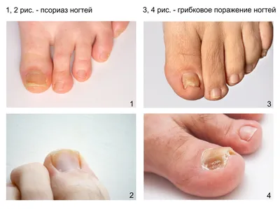 Чем лечить грибок ногтей на ногах в... - Фотоэпиляция ПМР | Facebook