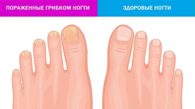 Лечение грибка на ногтях ног фото до и после | Клиника АЛОДЕРМ , Москва