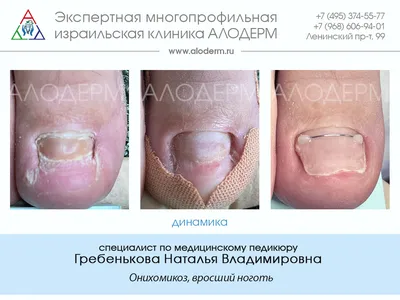 Грибок ногтей на ногах: стадии, лечение, профилактика в домашних условиях
