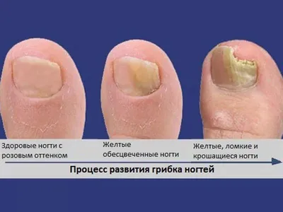 ГРИБОК НОГТЕЙ ИСЧЕЗНЕТ НАВСЕГДА, ЕСЛИ ЛЕЧИТЬ ЭТИМ СРЕДСТВОМ - YouTube