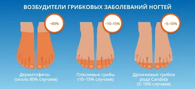 Лечение грибка ногтей в Кирове лазером в клинике Возрождение