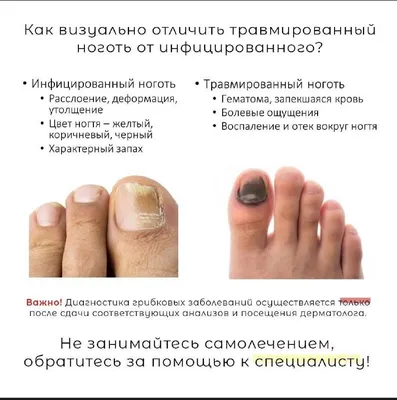 Как вылечить грибок ногтей
