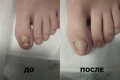 КАК НЕДОРОГО ВЫЛЕЧИТЬ ГРИБОК НОГТЕЙ В ДОМАШНИХ УСЛОВИЯХ крем из куркумы и  кокосового масла - YouTube