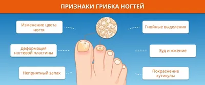 Грибок ногтей на ногах