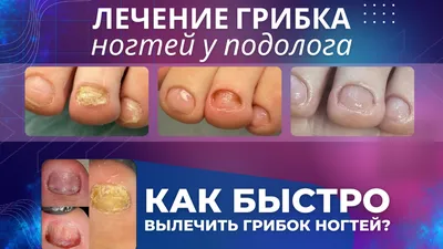 Грибковые заболевания ногтей: виды, симптомы, профилактика и лечение
