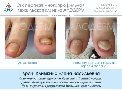 Грибок ногтей на ногах, лечение грибка ногтей в Днепре | Подо Центр Ольги  Пашиной