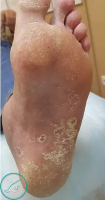 Лечение грибка кожи, ногтей, волос в Киеве | Brenner Clinic