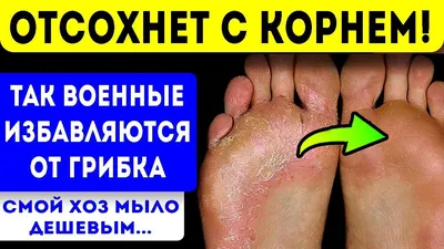 Непонятные образования на ступнях | Пикабу