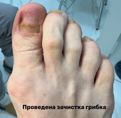 Грибок стопы. Лечение и профилактика. | Всё о медицине | Дзен