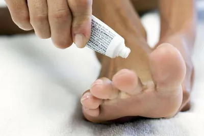 ❌Грибковое поражение кожи- дерматомикоз стоп❌ Причина: Грибок рода  Trichophyton rubrum. Симптомы: •Шелушение кожи •Покраснение и зуд… |  Instagram
