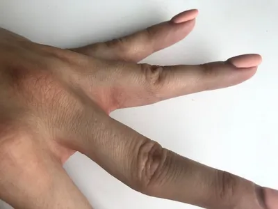 Микоз (грибок) на руках ❗️ ———————————————————————————————— Грибок, который  возникает на ногтях рук, является довольно часто встречающимся… | Instagram