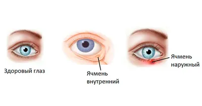 Ячмень на глазу лечение
